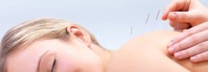 Acupuncture in Huntersville NC