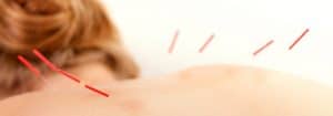 Trigger Points, Acupressure and Acupuncture