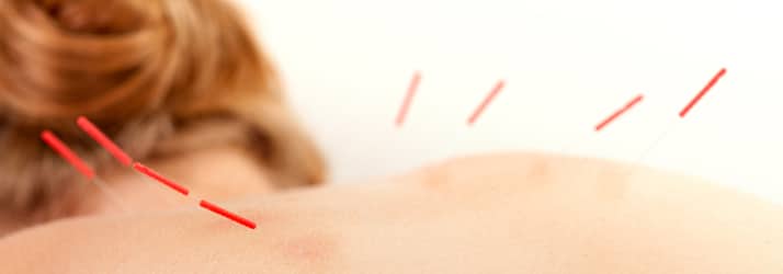 Acupuncture in Huntersville NC