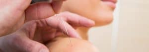 Acupuncture in Huntersville NC